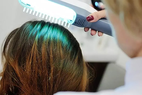 Liệu pháp laser kích thích mọc tóc