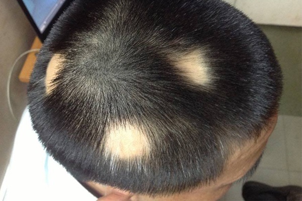 Hiện tượng rụng tóc từng mãng - Alopecia areata