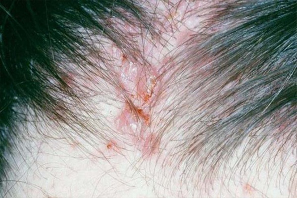 Giai đoạn 2 của nấm da đầu sẽ xuất hiện mụn