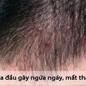 Nấm da đầu gây ảnh hưởng lớn tới cuộc sống của bệnh