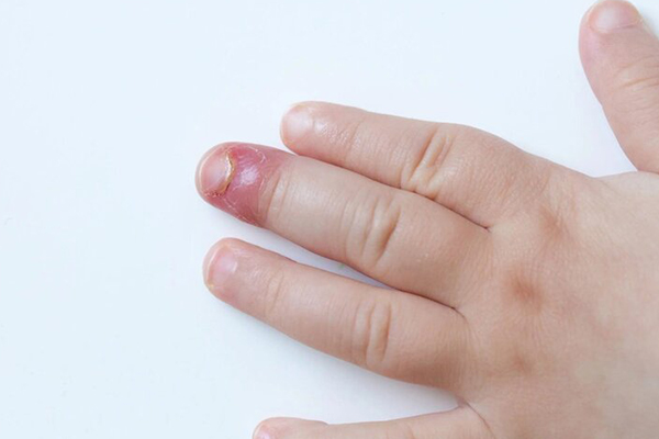 Biện pháp phòng ngừa bệnh nấm móng tay ở trẻ em